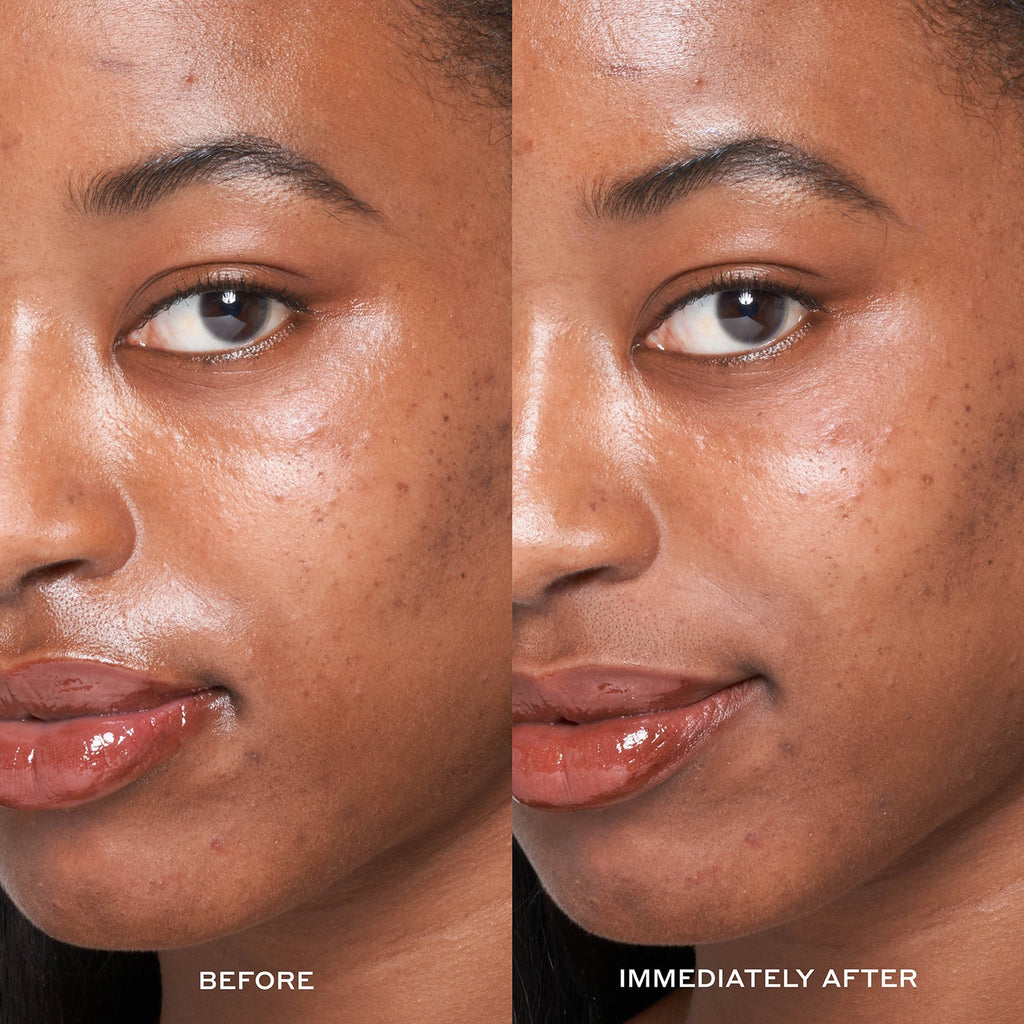 A before & immediately after image of a model who used the Dewtopia 25% Acid Flash Facial Mask.