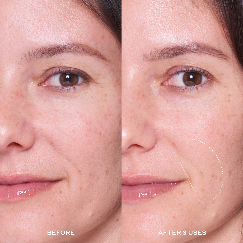 A before & after 3 uses image of a model who used the Dewtopia 25% Acid Flash Facial Mask.