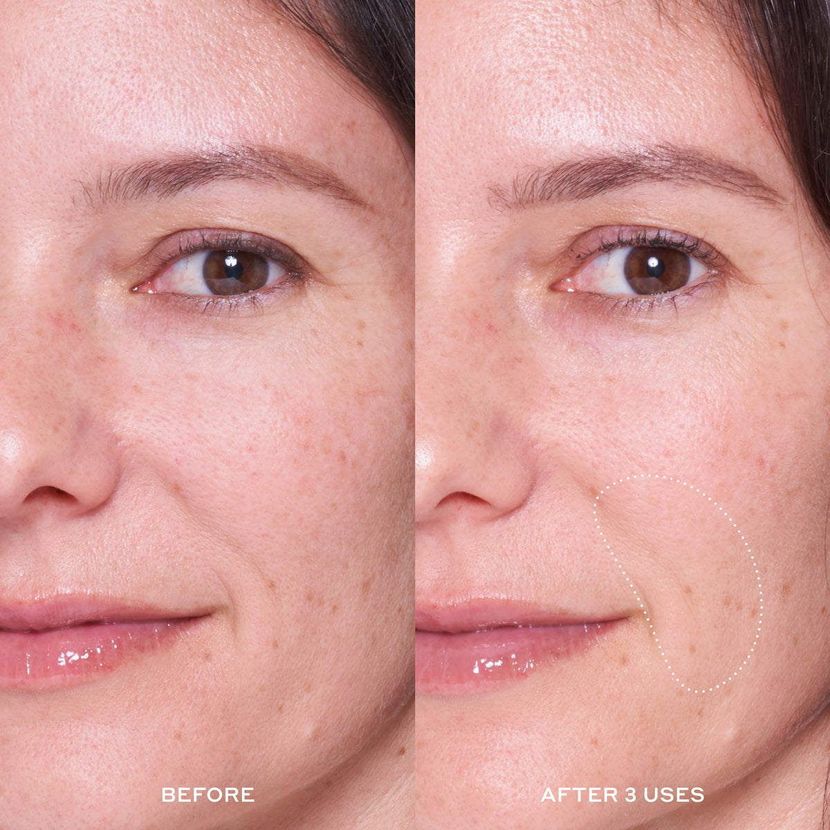 A before & after 3 uses image of a model who used the Dewtopia 25% Acid Flash Facial Mask.