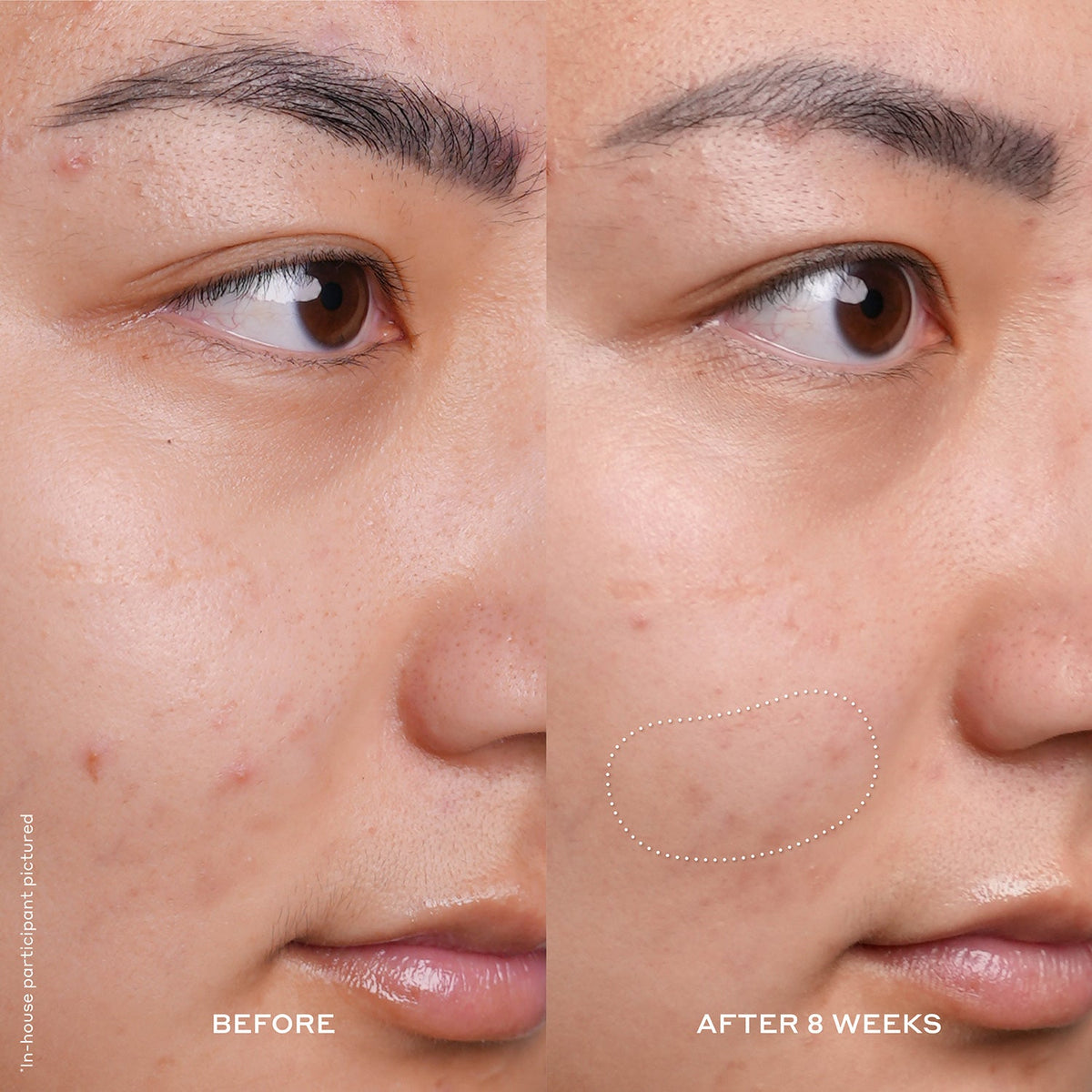 Before and After: Improved Skin Radiance and Smoothed Texture  after 8 weeks.